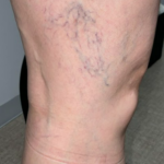 網の目状静脈瘤・クモの巣静脈瘤